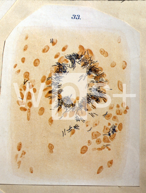 ｜コッホが描いた結核菌：巨大細胞の表面に対し垂直な縦軸をもつ特色ある状態の結核菌